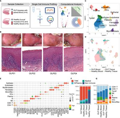 Frontiers Single Cell Immune Profiling Reveals Immune Responses In Oral Lichen Planus